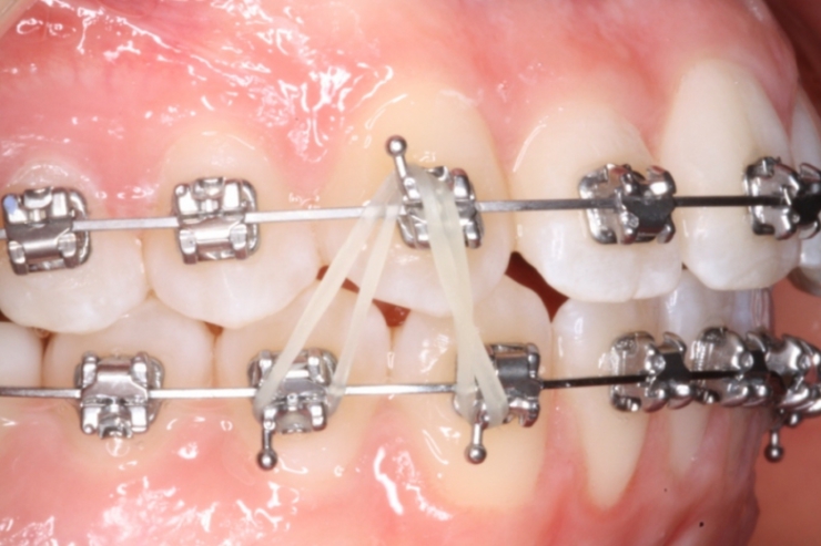 Les lastiques en orthodontie